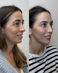 Before and after jawline filler results at HoneMD