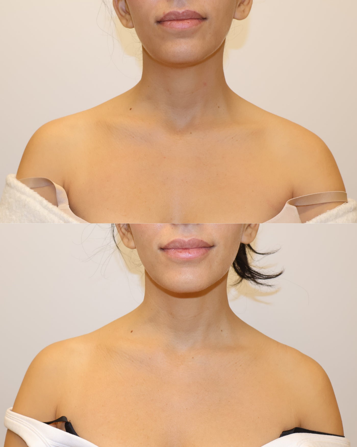 Before and after trap tox results showing neck and shoulders at HoneMD