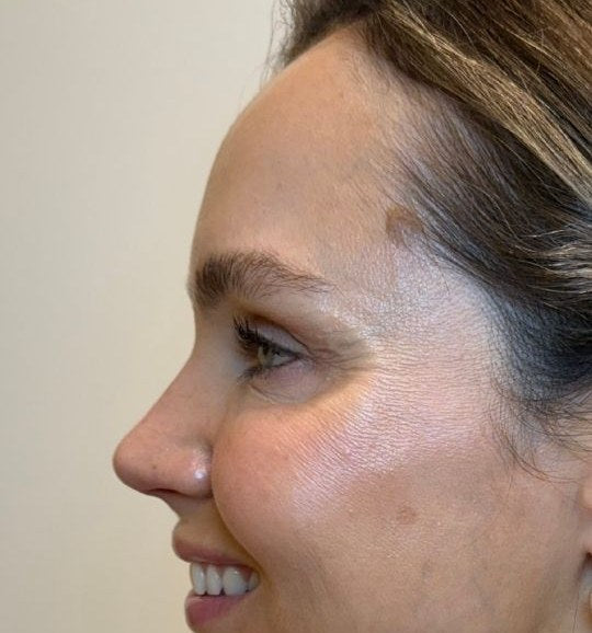 After — crow's feet softened, wrinkle relaxer