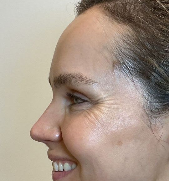 Before — crow's feet at rest