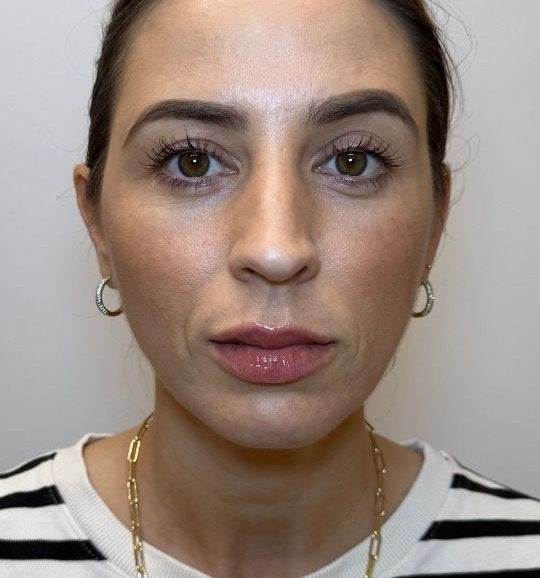 After — wrinkle relaxer and lip filler, full face