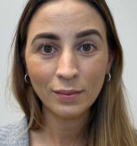 Before — forehead, frown lines and lips