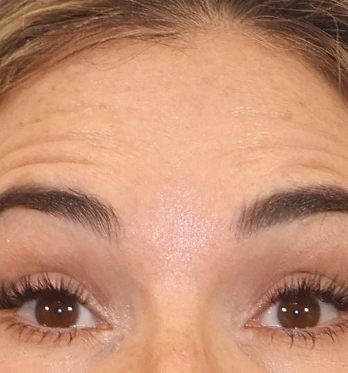 After — forehead smoothed, wrinkle relaxer