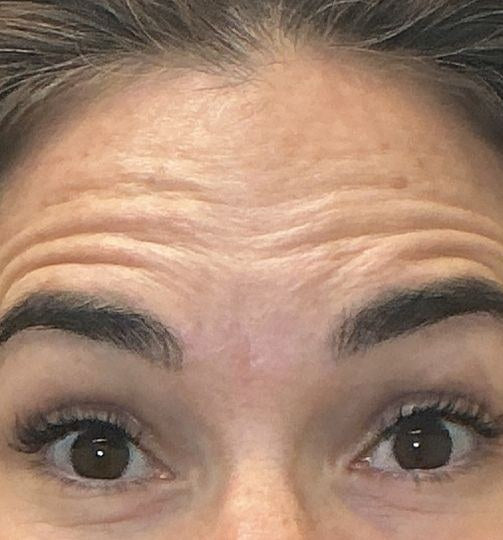 Before — forehead lines at rest