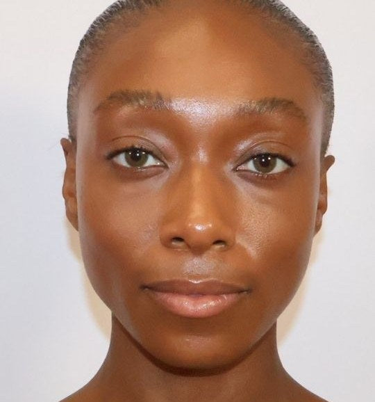 After — under-eye after microneedling and PRF