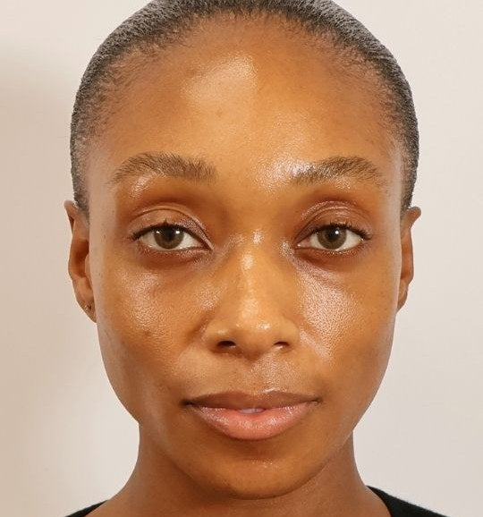 Before — under-eye texture