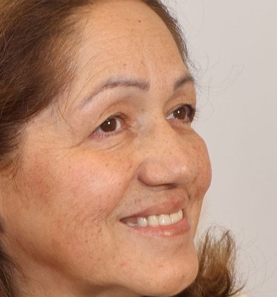 Before — crow's feet and forehead lines