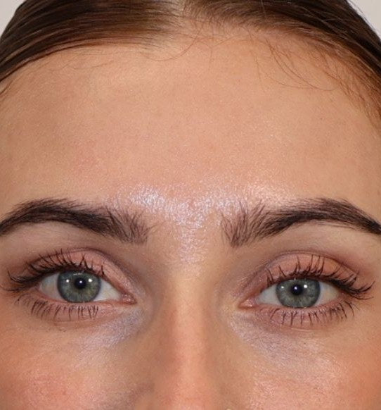 After — wrinkle relaxer, PRF and microneedling, full face