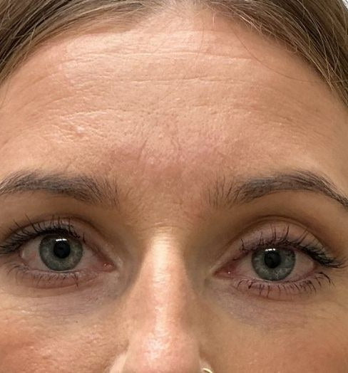 Before — forehead, crow's feet and under-eye