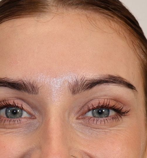 After — wrinkle relaxer, PRF and microneedling, full face