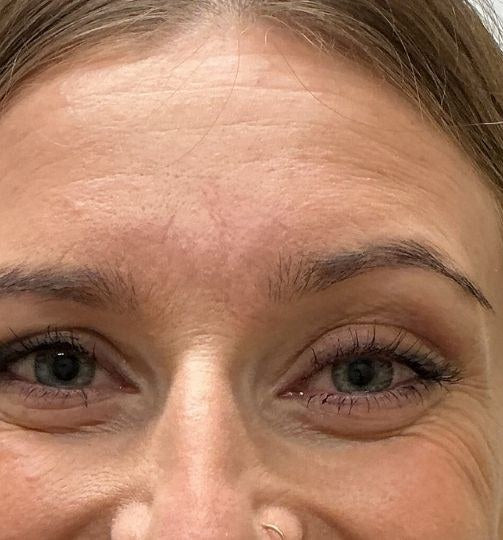 Before — forehead, crow's feet and under-eye