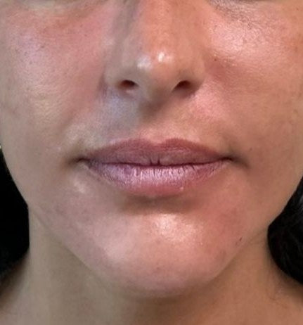 After — chin and jawline filler, front view