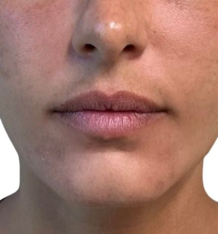 Before — chin and jawline, front view