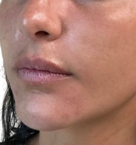After — chin and jawline filler, side view