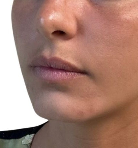 Before — chin and jawline, side view