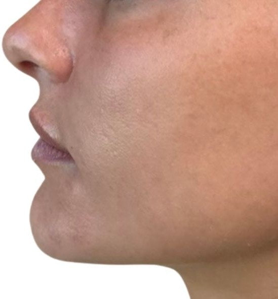After — chin filler, profile view