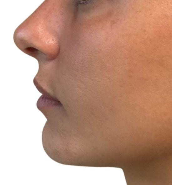 Before — chin profile
