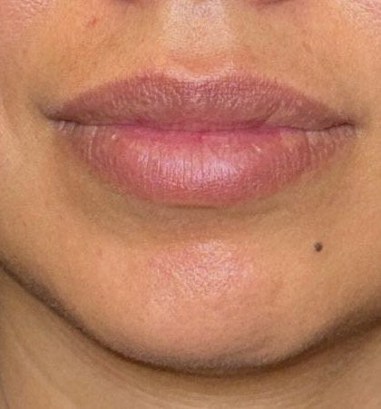 After — lip filler dissolved and rebuilt
