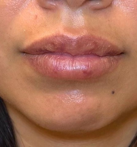Before — lips before dissolver