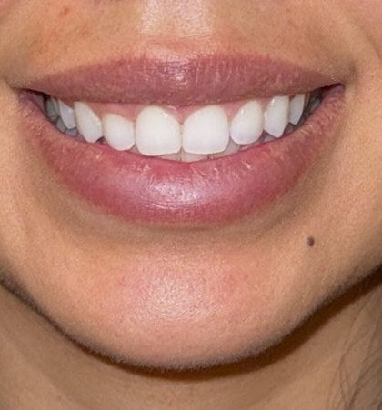 After — lip filler dissolved and rebuilt
