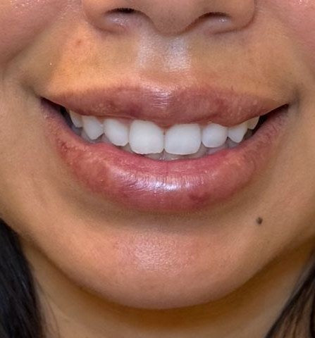 Before — lips before dissolver