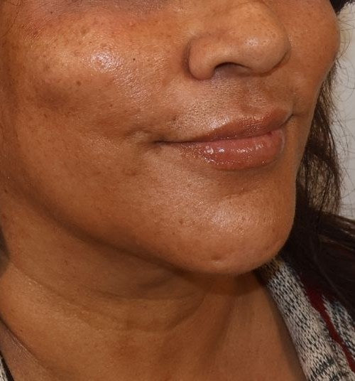After — chin and lip filler, three-quarter view