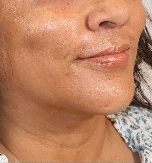 Before — chin and lips, three-quarter view