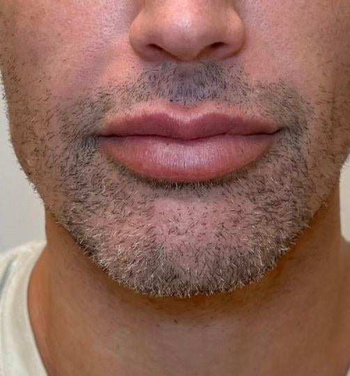 After — lip filler