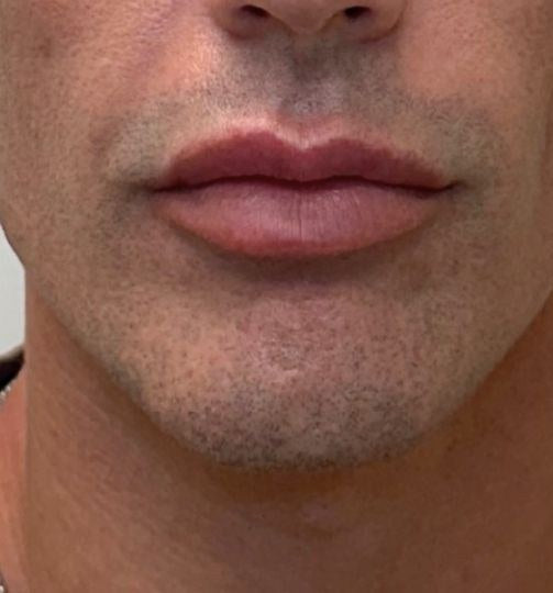 Before — lip volume and definition