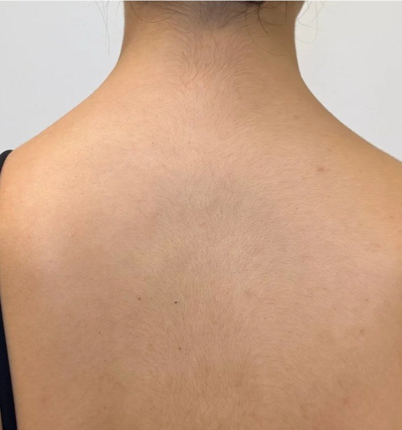 After — trap tox