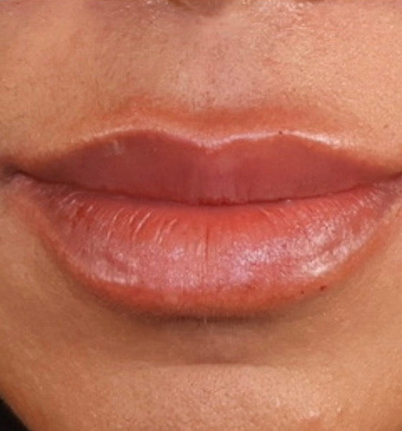 After lip filler - front close-up