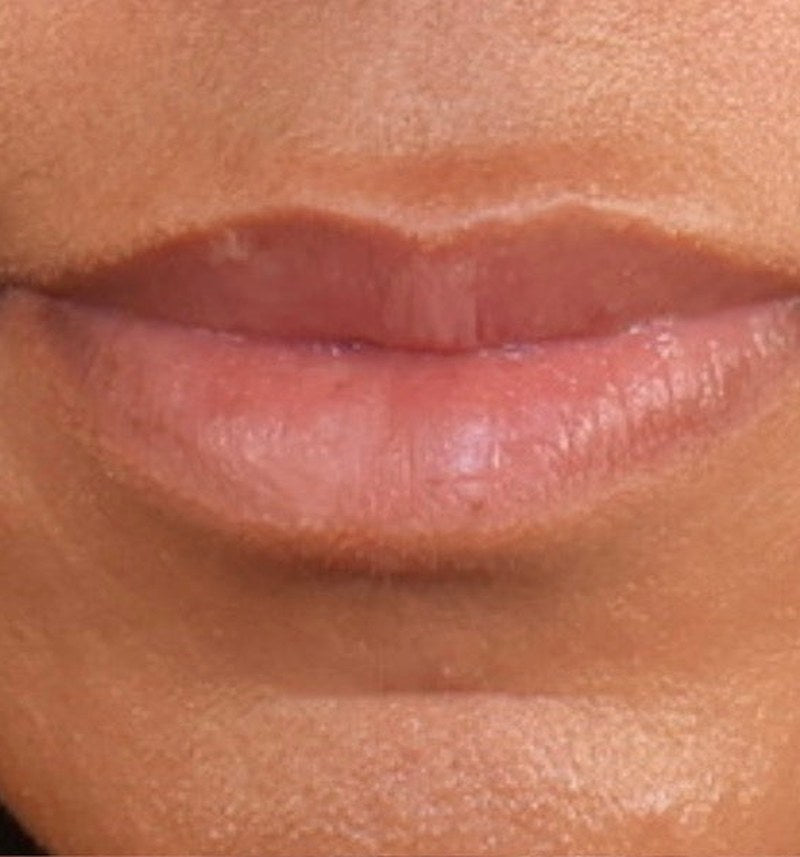 Before lip filler - front close-up