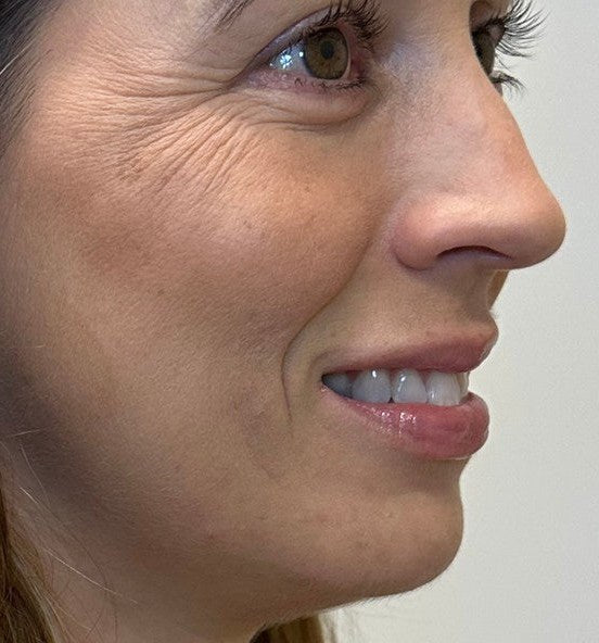 Before lip filler and facial balancing - three-quarter view
