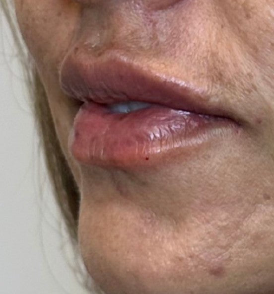 After lip filler - upper lip definition