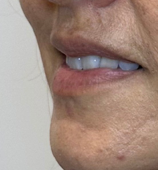 Before lip filler - upper lip definition