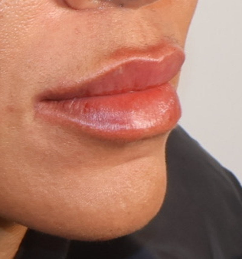 After lip filler - three-quarter view