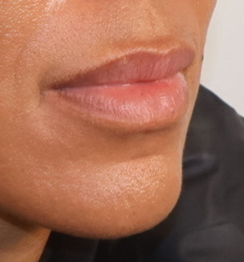 Before lip filler - three-quarter view