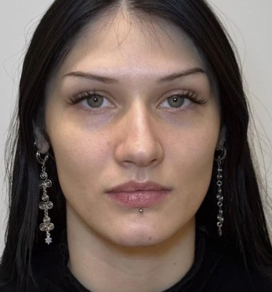 Before cheek and jawline contouring