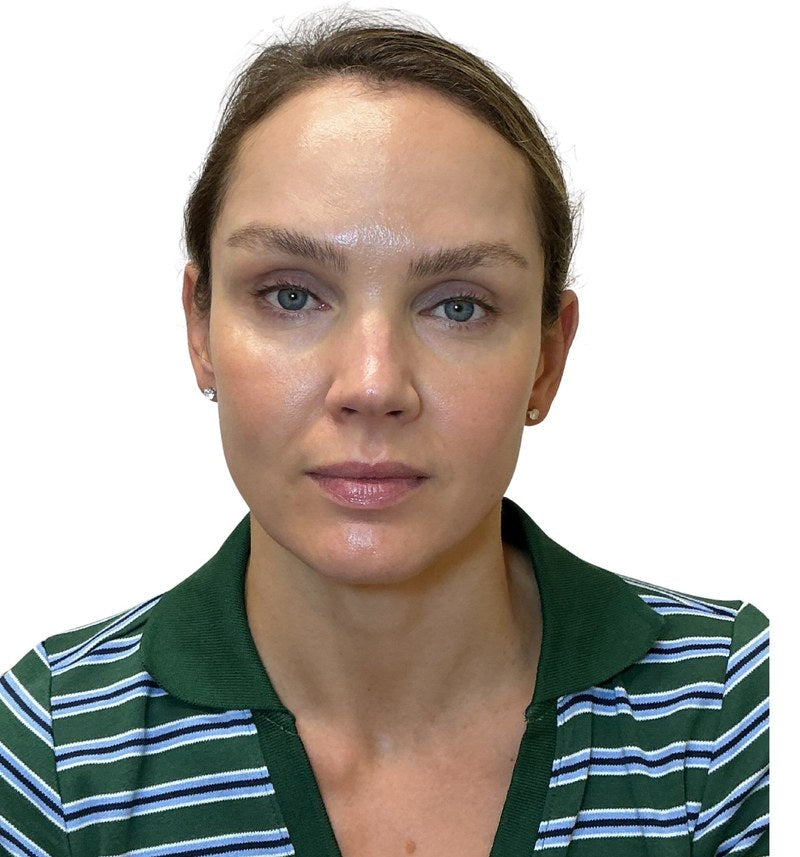 After wrinkle relaxer - forehead