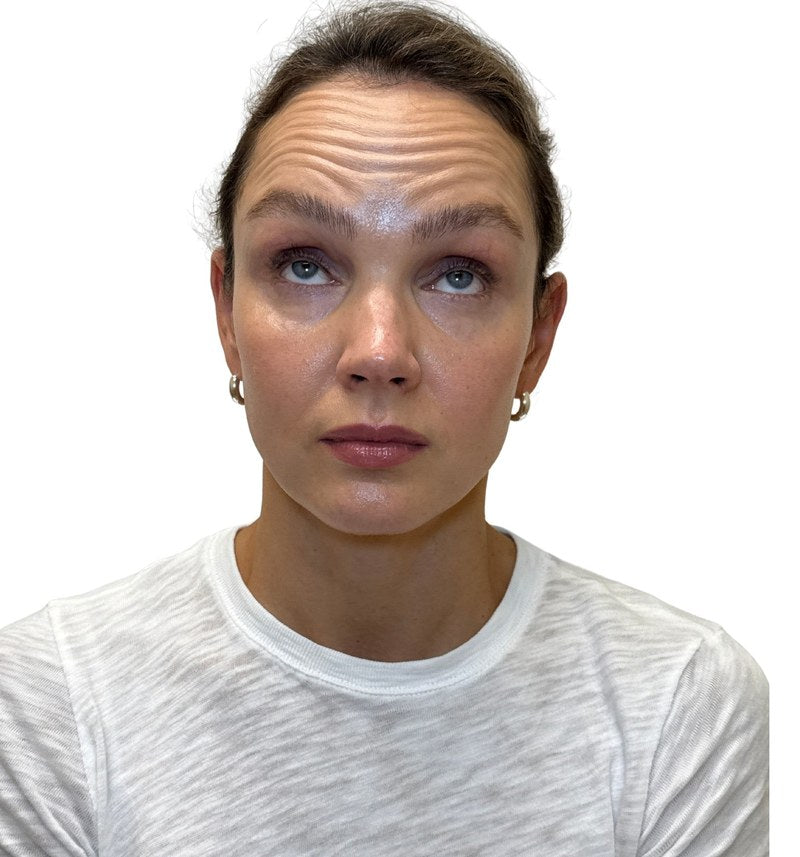 Before wrinkle relaxer - forehead